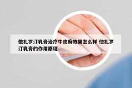 他扎羅汀乳膏治療牛皮癬效果怎么樣 他扎羅汀乳膏的作用原理