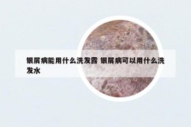 銀屑病能用什么洗發(fā)露 銀屑病可以用什么洗發(fā)水
