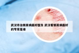武漢市治銀屑病最好醫(yī)生 武漢看銀屑病最好的專家是誰