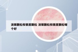 消銀顆粒和銀屑顆粒 消銀顆粒和銀屑顆粒哪個(gè)好