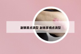 副銀屑點滴型 副銀屑病點滴型