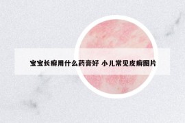 寶寶長癬用什么藥膏好 小兒常見皮癬圖片