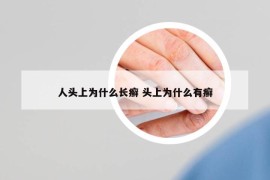 人頭上為什么長(zhǎng)癬 頭上為什么有癬