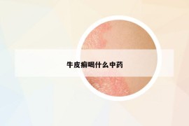 牛皮癬喝什么中藥