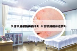 頭部銀屑病能要孩子嗎 頭部銀屑病會(huì)遺傳嗎