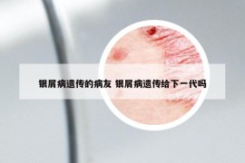 銀屑病遺傳的病友 銀屑病遺傳給下一代嗎