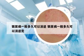 銀屑病一般多久可以消退 銀屑病一般多久可以消退完