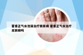 藿香正氣水泡澡治療銀屑病 霍香正氣水治療皮膚癬嗎