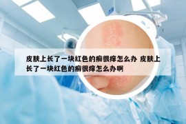 皮膚上長了一塊紅色的癬很癢怎么辦 皮膚上長了一塊紅色的癬很癢怎么辦啊