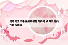 虎毒膏治療牛皮癬斷根是真的嗎 虎毒乳膏的作用與功效