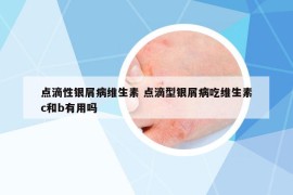 點(diǎn)滴性銀屑病維生素 點(diǎn)滴型銀屑病吃維生素c和b有用嗎