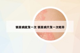 銀屑病就發(fā)一次 銀屑病只發(fā)一次概率