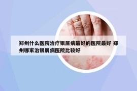 鄭州什么醫(yī)院治療銀屑病最好的醫(yī)院最好 鄭州哪家治銀屑病醫(yī)院比較好
