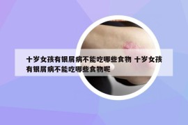 十歲女孩有銀屑病不能吃哪些食物 十歲女孩有銀屑病不能吃哪些食物呢