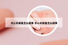 手心長癬是怎么回事 手心長蘚是怎么回事