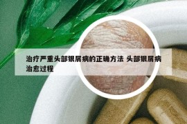 治療嚴(yán)重頭部銀屑病的正確方法 頭部銀屑病治愈過(guò)程