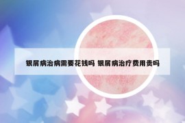 銀屑病治病需要花錢嗎 銀屑病治療費(fèi)用貴嗎