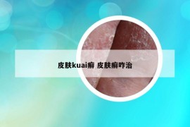皮膚kuai癬 皮膚癬咋治