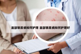 面部銀屑病如何護理 面部銀屑病如何護理好