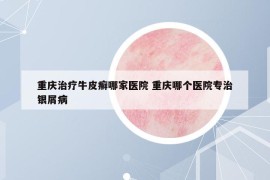 重慶治療牛皮癬哪家醫(yī)院 重慶哪個醫(yī)院專治銀屑病