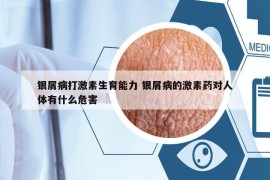 銀屑病打激素生育能力 銀屑病的激素藥對人體有什么危害