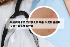 銀屑病用卡泊三醇多久有效果 頭皮銀屑病用卡泊三醇多久有效果