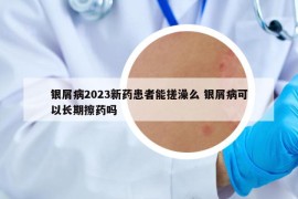 銀屑病2023新藥患者能搓澡么 銀屑病可以長(zhǎng)期擦藥嗎