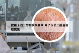 使用卡泊三醇后皮損變大 用了卡泊三醇后皮膚變黑