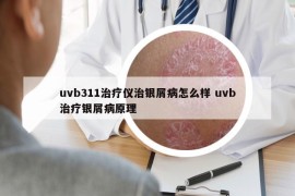 uvb311治療儀治銀屑病怎么樣 uvb治療銀屑病原理