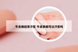 牛皮癬經(jīng)常汗蒸 牛皮膚癬可以汗蒸嗎