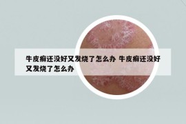 牛皮癬還沒好又發(fā)燒了怎么辦 牛皮癬還沒好又發(fā)燒了怎么辦