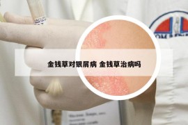 金錢草對銀屑病 金錢草治病嗎