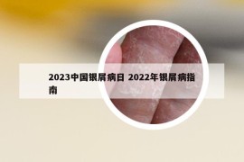 2023中國(guó)銀屑病日 2022年銀屑病指南