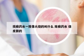 找癬藥水一擦像火燒的叫什么 除癬藥水 燒皮膚的