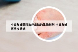 中曰友好醫(yī)院治療皮膚的生物制劑 中日友好醫(yī)院皮膚病