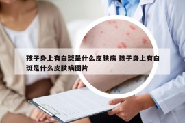 孩子身上有白斑是什么皮膚病 孩子身上有白斑是什么皮膚病圖片