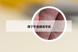 得了牛皮癬關(guān)節(jié)炎