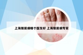 上海銀屑病哪個(gè)醫(yī)生好 上海銀屑病專家