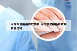 治療銀皮癬最有效的藥 治療銀皮癬最有效的藥膏是啥