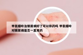 甲氨蝶呤治銀屑病好了可以停藥嗎 甲氨蝶呤對銀屑病是否一直用藥