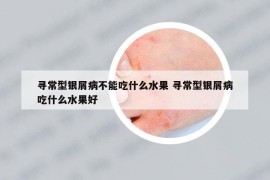 尋常型銀屑病不能吃什么水果 尋常型銀屑病吃什么水果好