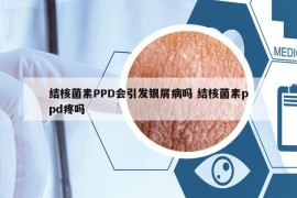 結(jié)核菌素PPD會引發(fā)銀屑病嗎 結(jié)核菌素ppd疼嗎