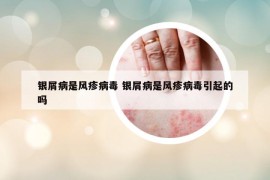 銀屑病是風(fēng)疹病毒 銀屑病是風(fēng)疹病毒引起的嗎