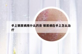 手上銀屑病用什么藥膏 銀屑病在手上怎么治療