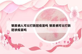 銀屑病人可以打新冠疫苗嗎 銀屑病可以打新冠狀疫苗嗎