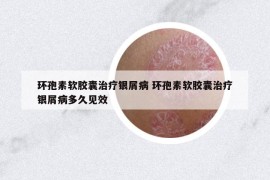 環(huán)孢素軟膠囊治療銀屑病 環(huán)孢素軟膠囊治療銀屑病多久見(jiàn)效