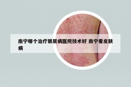 南寧哪個(gè)治療銀屑病醫(yī)院技術(shù)好 南寧看皮膚病