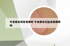 牛皮癬會渾身發(fā)癢嗎 牛皮癬會引起皮膚瘙癢嗎