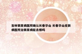 吉林銀屑病醫(yī)院確認(rèn)長春華山 長春華山皮膚病醫(yī)院治銀屑病能去根嗎