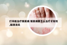 打吊瓶治療銀屑病 銀屑病要怎么治療才有效,輸液消炎